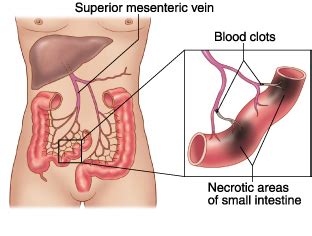 emDOCs.net – Emergency Medicine EducationMesenteric Ischemia: A Power Review - emDOCs.net ...