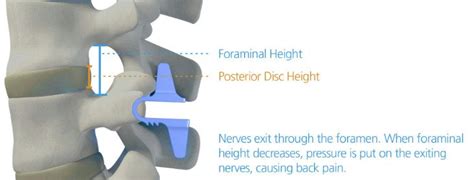 Interspinous Spacer Device | London Spine Unit | UK's Best Spinal Clinic | Harley Street