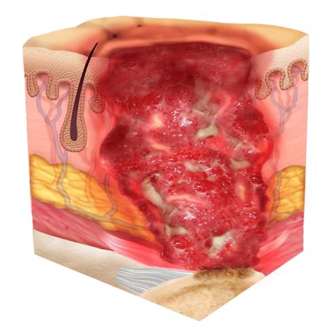 Pressure Injury 101: Stage 4 Pressure Ulcers