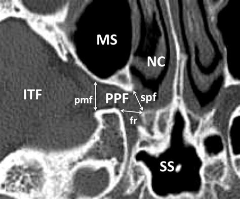 Contents Of Infratemporal Fossa