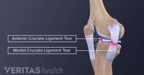 Symptoms of MCL Sprains and Tears