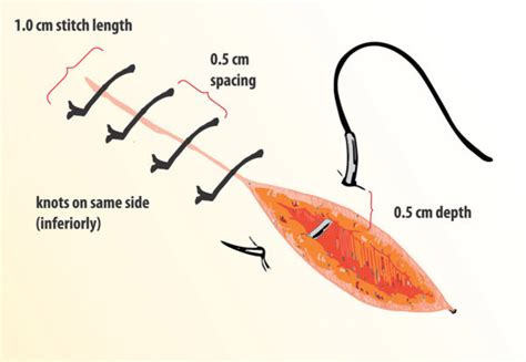 interrupted-suture – How to Pace