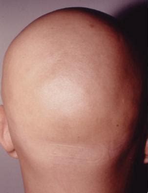 US Hair Transplant » alopecia universalis