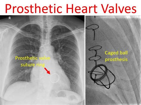 Prosthetic heart valves – All About Cardiovascular System and Disorders