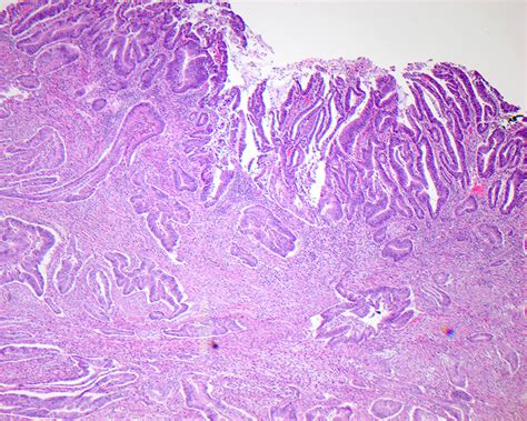 Pathology Outlines - Adenocarcinoma-small intestine