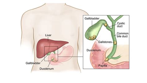 Best Bile Duct Stone Treatment