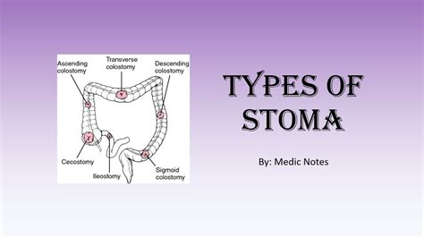 Types of stoma - colostomy/ileostomy/urostomy, end/loop/double-barrel ...