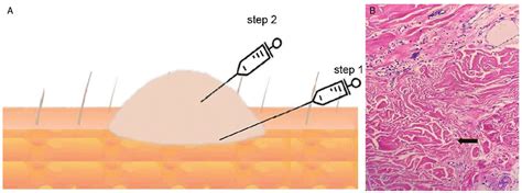 Modified injection technique for improving the treatment of keloids ...