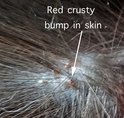 Flea Bite Allergy – feline miliary dermatitis