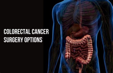 Surgical options for colorectal cancer: what to expect before, during ...