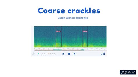 Lung sounds - coarse crackles - YouTube