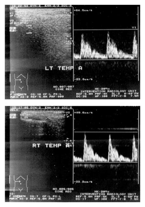 Duplex ultrasound of the temporal arteries. The diameter of the right ...