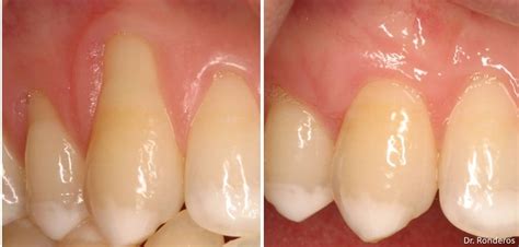 Gingival (Gum) Recession Redwood City CA, Mauricio Ronderos, DDS, MS, MPH