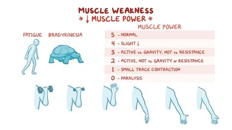 Muscle weakness: Clinical: Video, Anatomy & Definition | Osmosis