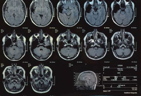 Brain tumour surgery: experts call for change to improve survival - The ...