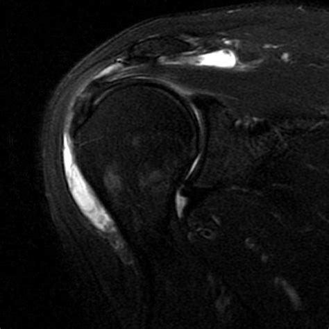 Bursitis MRI - wikidoc