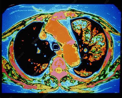 CT scan of a lung with emphysema - Stock Image - M150/0084 - Science Photo Library