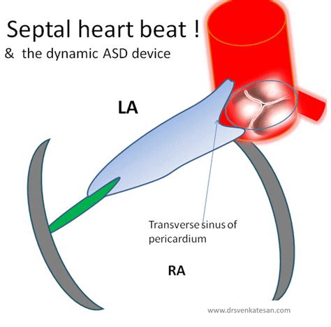 Aortic erosion following ASD device closure : A reality check ...