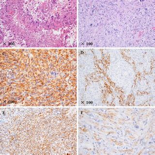 Histology of glioblastoma multiforme and gliosarcoma are shown. a... | Download Scientific Diagram