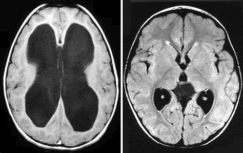 Hydrocephalus - Seattle Children's Hospital