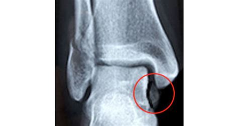 Ankle Avulsion Fracture - Symptoms, Causes & Treatment