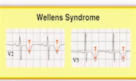 Rare Case of Wellens syndrome progressing from type A to classic type B ...