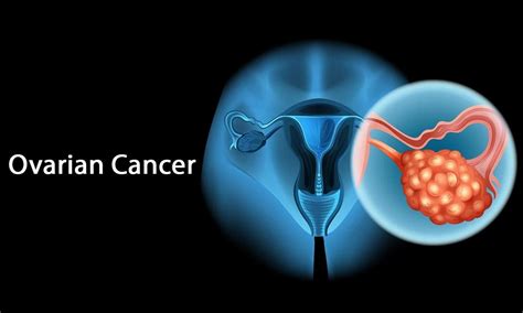 Ayurvedic Remedies For The Treatment For Ovarian Cancer