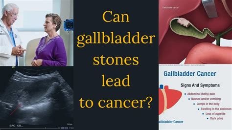 Gallbladder cancer, symptoms, causes, diagnosis & treatment