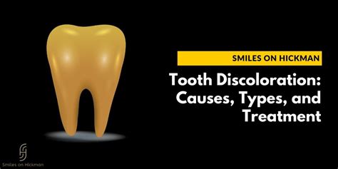 Tooth Discoloration: Causes, Types, and Treatment | Posts by Smilesonhickman | Bloglovin’