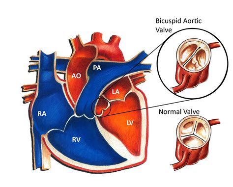 Bicuspid Aortic Valve - Pediatric Heart Specialists