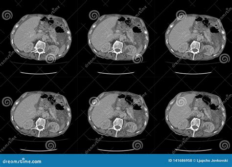 Computed Tomography CT Whole Abdomen in Axial. Part Fifteen Stock Photo - Image of neuron ...