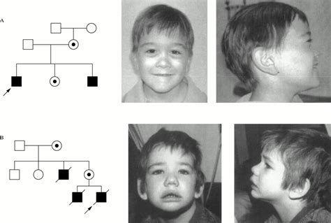 Alport syndrome and mental retardation: clinical and genetic dissection of the contiguous gene ...