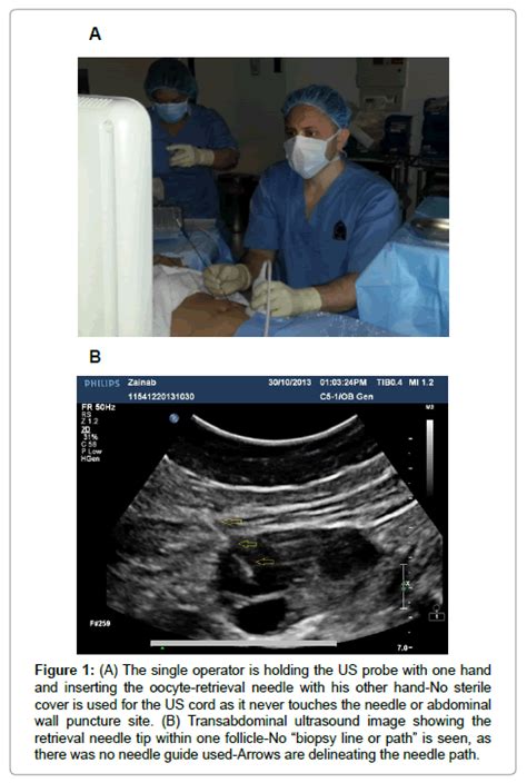 gynecology-obstetrics-oocyte-retrieval-needle