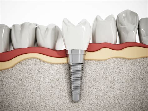 Dental Implant vs Crown - Which Is the Best? - FIT Orbit