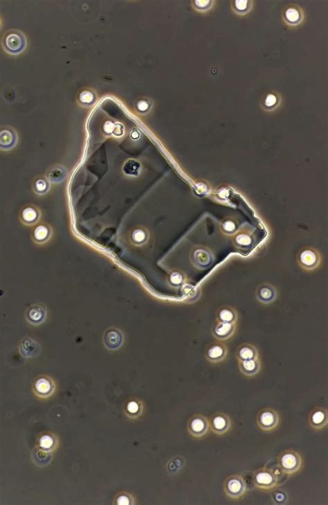 Urine Sediment of the Month: All About Those Oval Fat Bodies - Renal ...