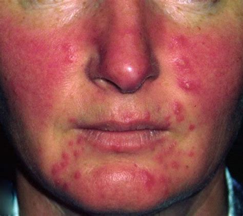 Rosacea - Pictures, Treatment, Symptoms, Causes, Diet, Prevention ...