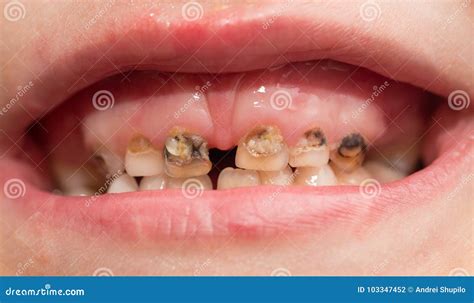 Rotten Teeth. Royalty-Free Stock Image | CartoonDealer.com #35981548