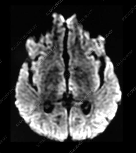 Wernicke's Encephalopathy on MRI - Stock Image - C043/0253 - Science ...