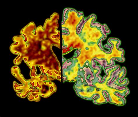 Cerebral (Brain) Atrophy and Shrinkage