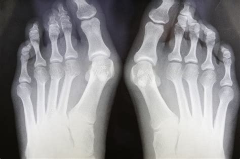 Patient Experience - A Bunion in London | Complete Physio