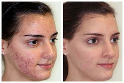 Plastic Surgery Before And After: Microdermabrasion Before And After