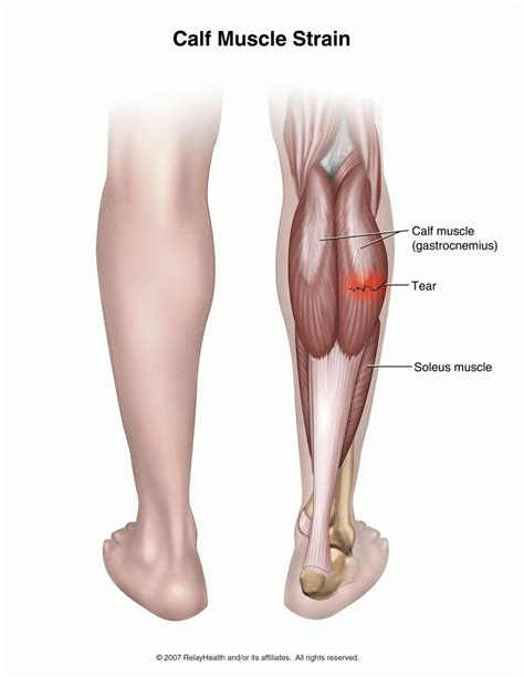 Calf Strain Doctor | Singapore Sports & Orthopaedic Surgeon