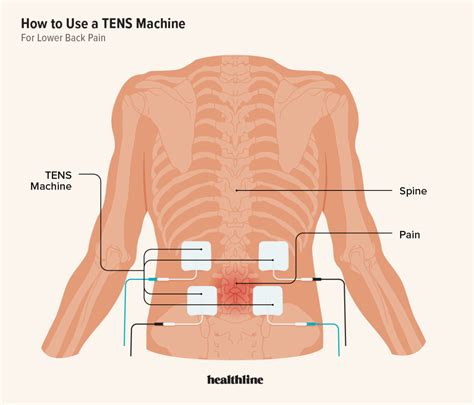 TENS Unit for Lower Back Pain: Placement and Instructions