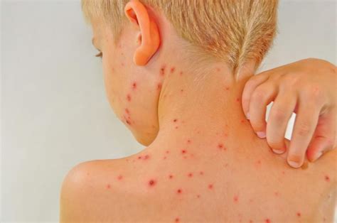 Chickenpox: characteristics, treatments and preventions