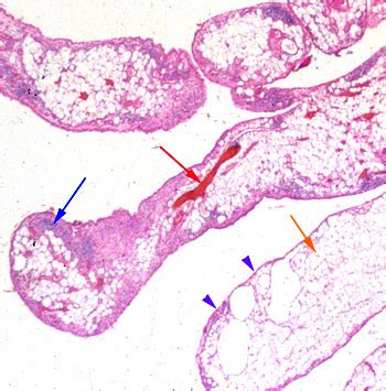 Lipoma Arborescens | Radsource