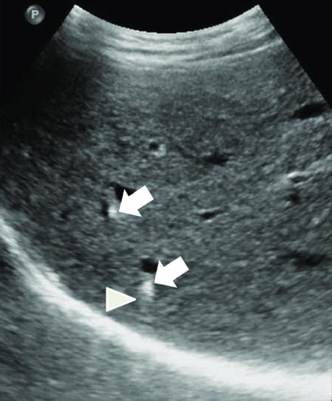 Liver Lesions Ultrasound