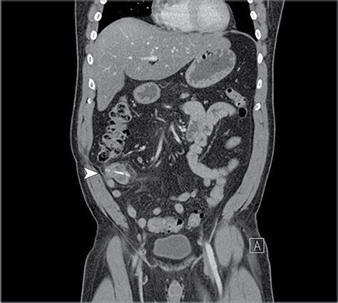 An Unusual Cause of Intestinal Perforation | Gastrointestinal Surgery ...