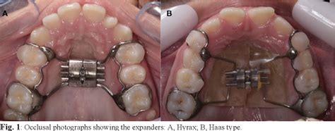 Figure 1 from Tomographic evaluation of dentoskeletal effects of rapid maxillary expansion using ...