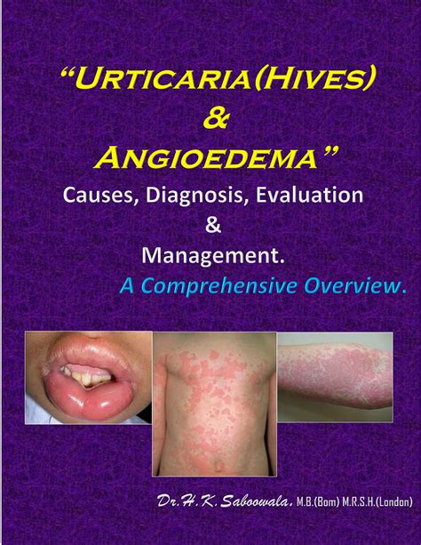 Buy “Urticaria (Hives) & Angioedema”-Causes, Diagnosis, Evaluation & Management. A Comprehensive ...