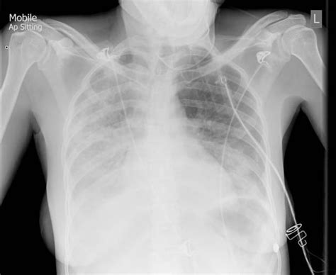 Right hemithorax ... | Radiology, Atypical, Pneumonia